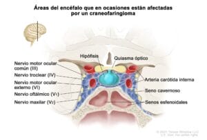 terapias freno tumores cerebrales