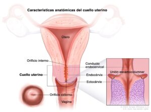 cáncer de cuello de útero