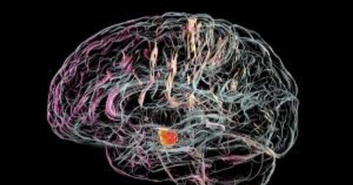 parkinson