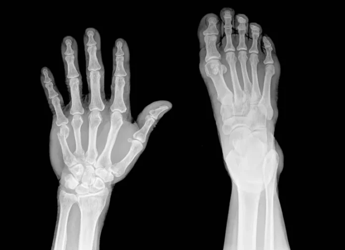 fractura de dedo