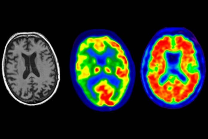 alzheimer_atrofia_cerebral alzheimer