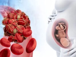 embolia pulmonar en gestantes