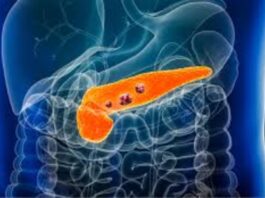 cáncer de pancreas