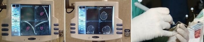 neuronavegación