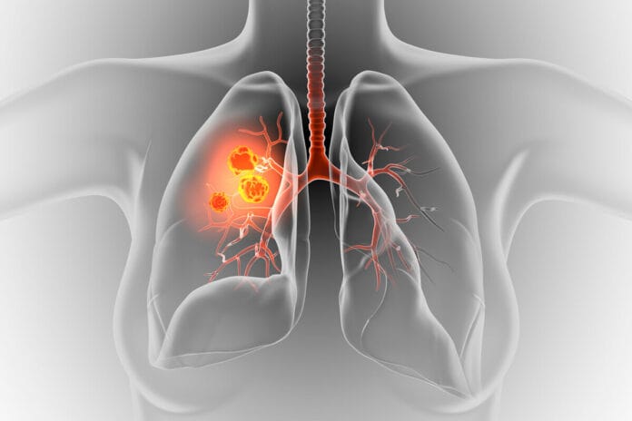 cáncer de pulmón