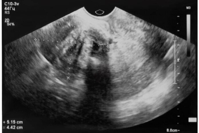 mioma uterino