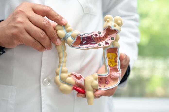 cáncer de colon