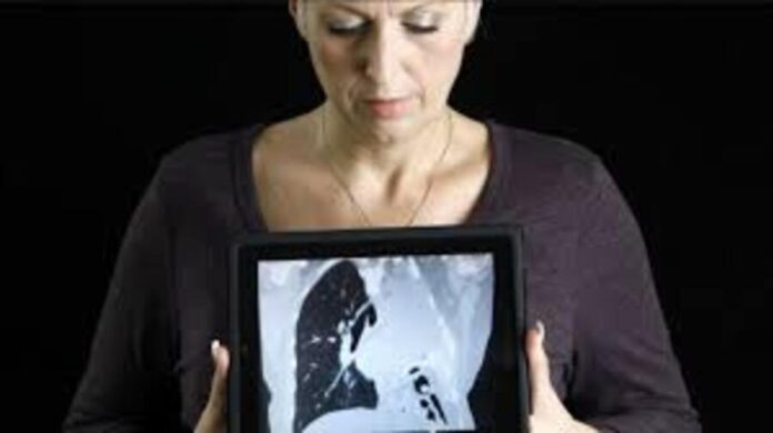 cáncer de pulmón mujer