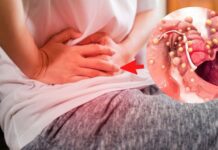 El cáncer silencioso que aún llegamos tarde a detectar cáncer de colon