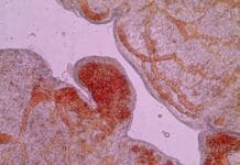 El desprendimiento de placenta eleva el riesgo de patología cardíaca del nacido a largo plazo
