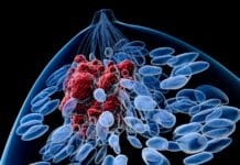 El análisis genético predice la respuesta a la quimioterapia en el cáncer de mama