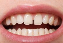 Caries en dientes de leche, por qué pueden aparecer antes de los dos años y cómo detectarlas caries dientes de leche