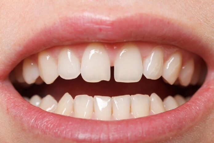 caries dientes de leche