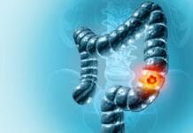 Reto en cáncer de colon: «Diagnosticar antes, aumentar la participación en cribado y personalizar tratamientos» cáncer colorrectal