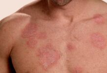 Uno de cada tres pacientes con lupus reclama más atención a la salud renal y revela carencias en información y apoyo psicológico lupus