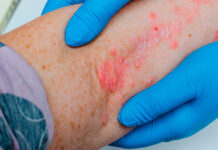 Icotrokinra irrumpe en psoriasis y se sitúa como el oral más eficaz hasta la fecha psoriasis