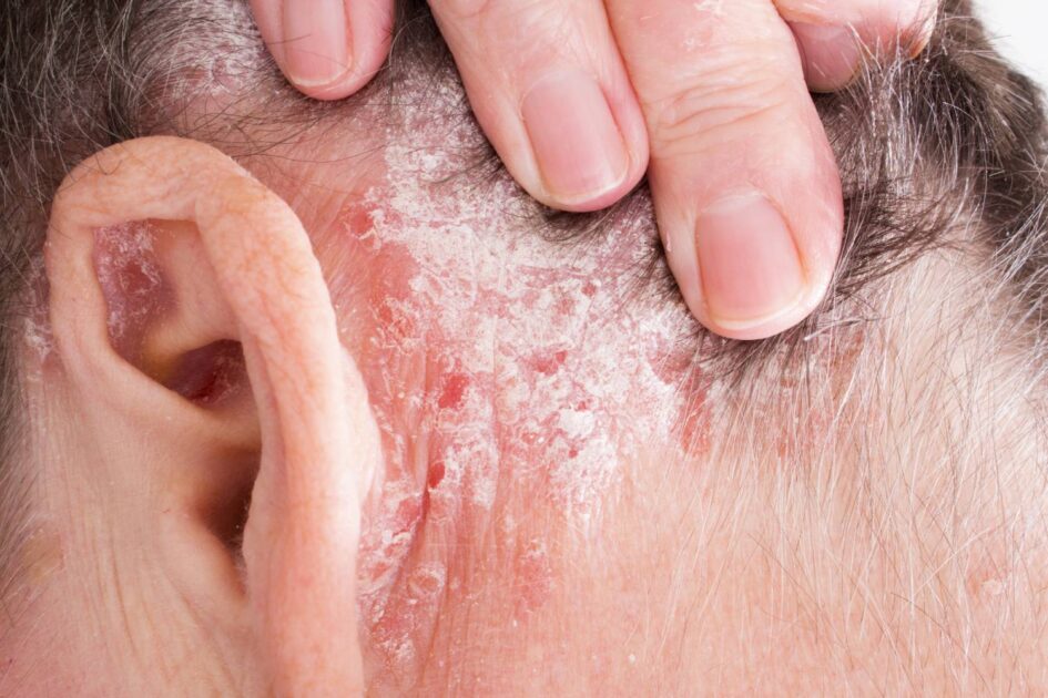 psoriasis