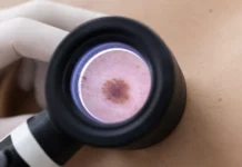 HLA realiza más de 7.000 consultas dermatológicas en Zaragoza en 2025