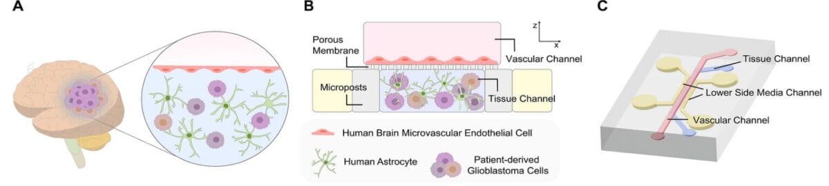 glioblastoma 1