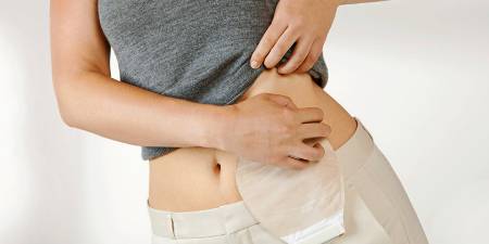 paciente ostomizado