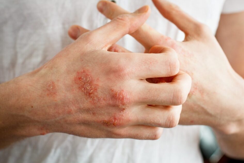 dermatitis atópica